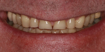 Before & After: Complete Denture Before
